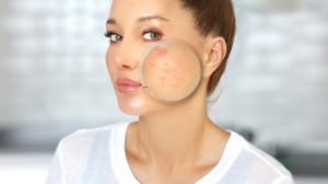 How to get rid of acne scars Rancho Cucamonga